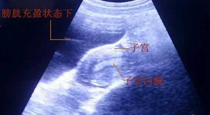 广州好孕妈妈_营口姐妹为啥试管婴儿胚胎移植前要憋尿呢？